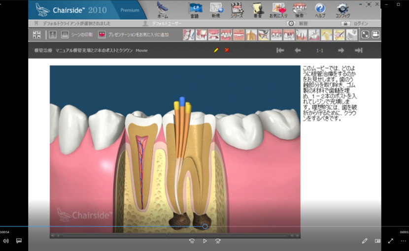 11歯内療法　B歯内療法　根管治療　マニュアル根管治療と2本のポストクラウン