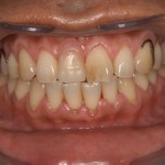 インプラント専門の歯科