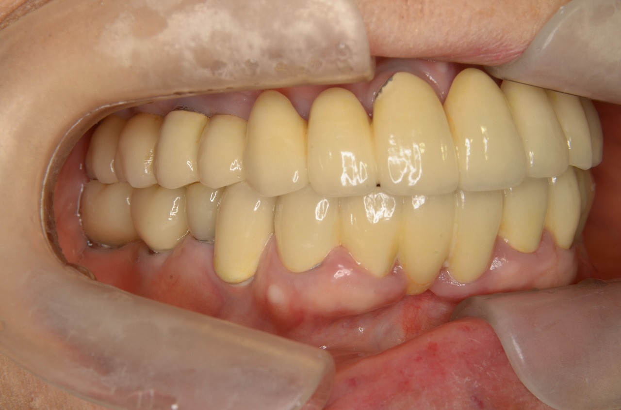 インプラント専門の歯科